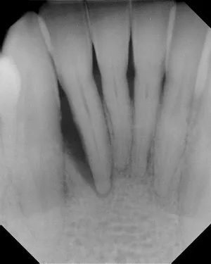 Before and After X-rays