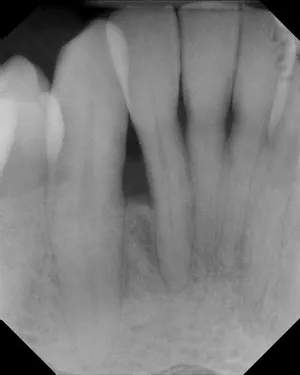Before and After X-rays