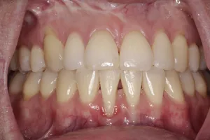 Gum Recession Photos