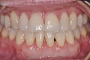 Gum Recession Photos